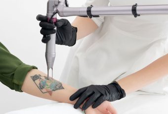 Laser Tattoo RemovalNear Me – Expert Laser Tattoo Removal in Cincinnati, OH
