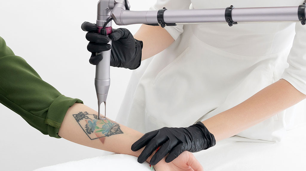 Tattoo removal near me cost