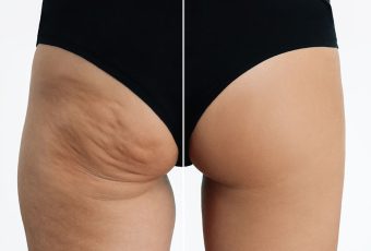 What Treatment is Best for Cellulite?