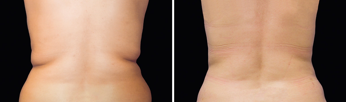 coolsculpting before and after how to lose love handles