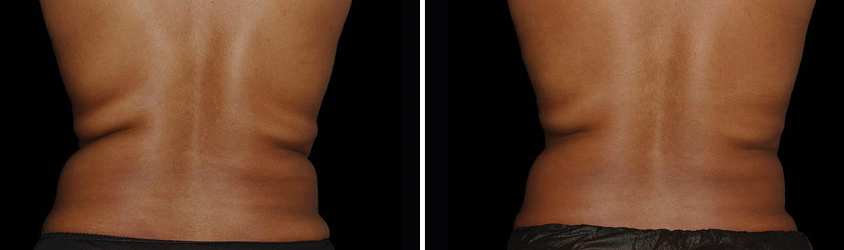 coolsculpting before and after how to lose love handles