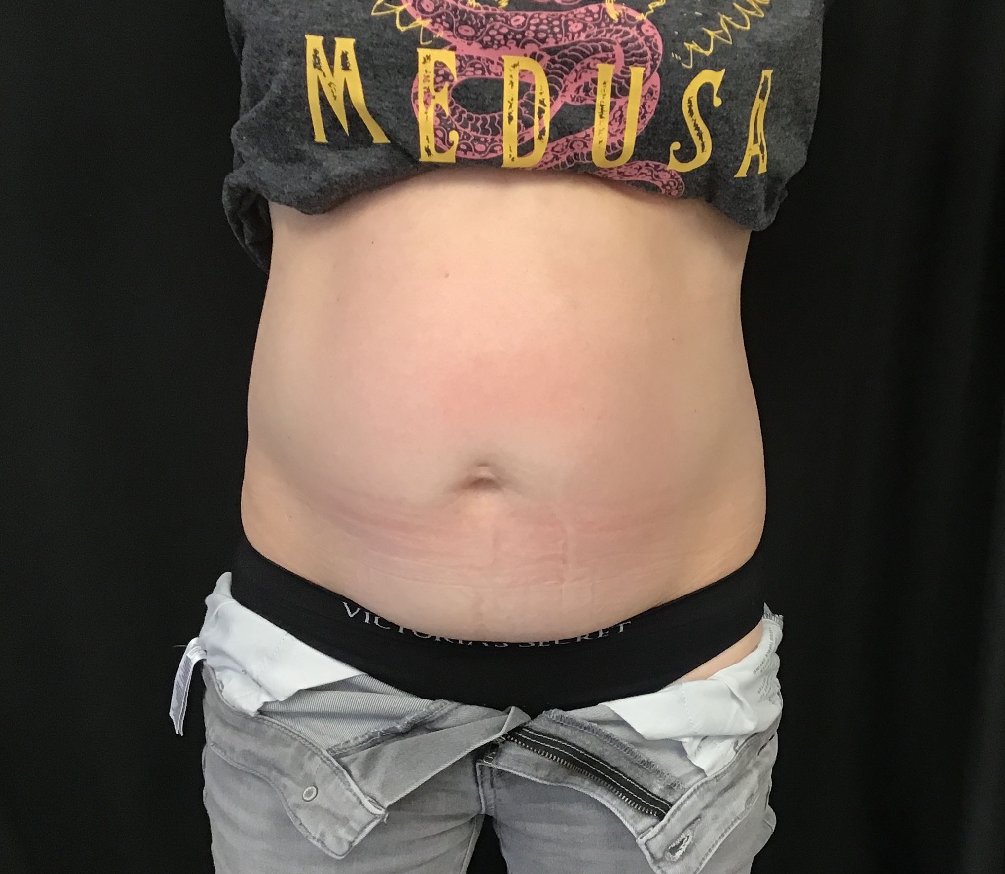 tummy tuck abdominoplasty before and after results cincinnati ohio