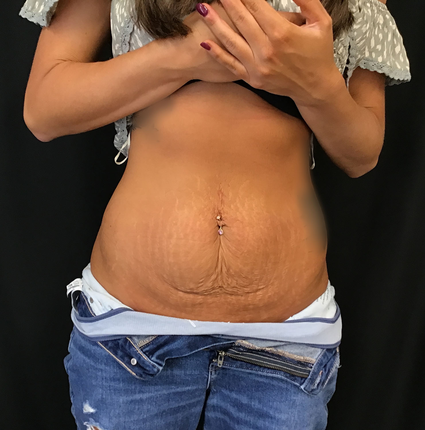 tummy tuck abdominoplasty before and after results cincinnati ohio