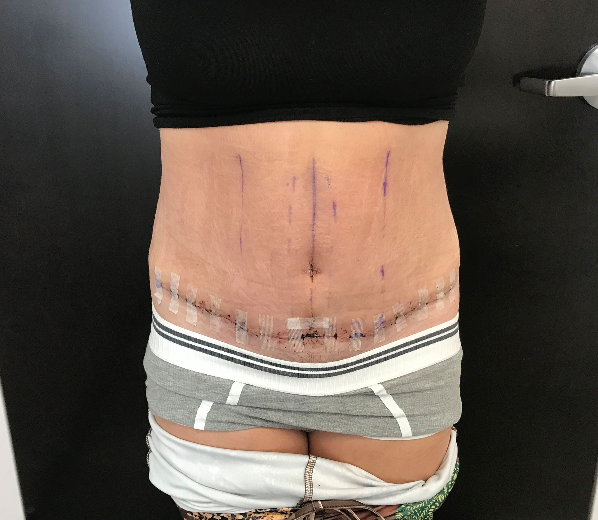 tummy tuck abdominoplasty before and after results cincinnati ohio