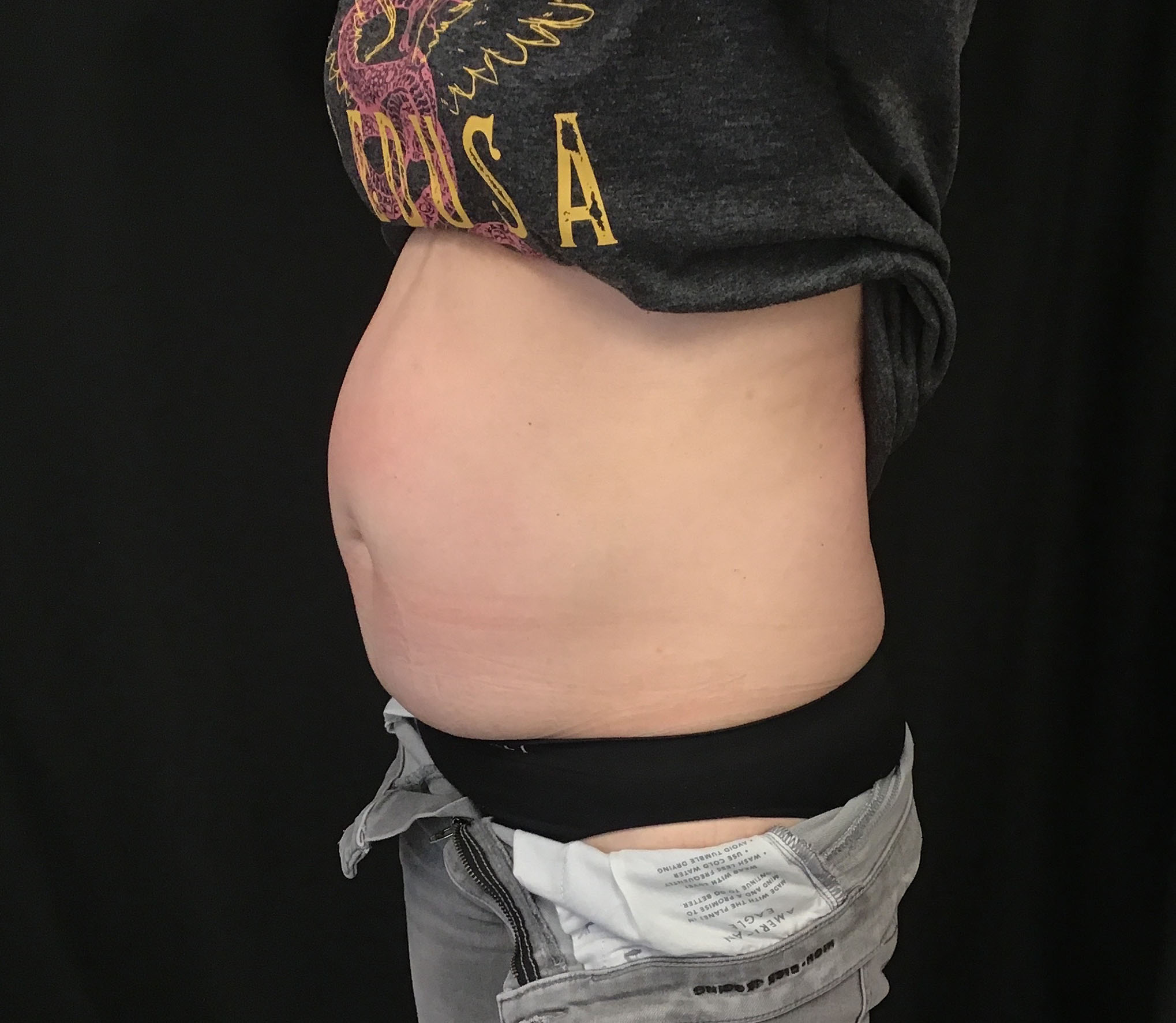 tummy tuck abdominoplasty before and after results cincinnati ohio