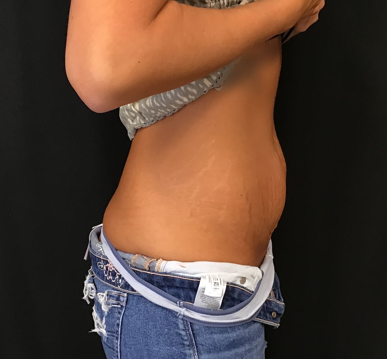 tummy tuck abdominoplasty before and after results cincinnati ohio