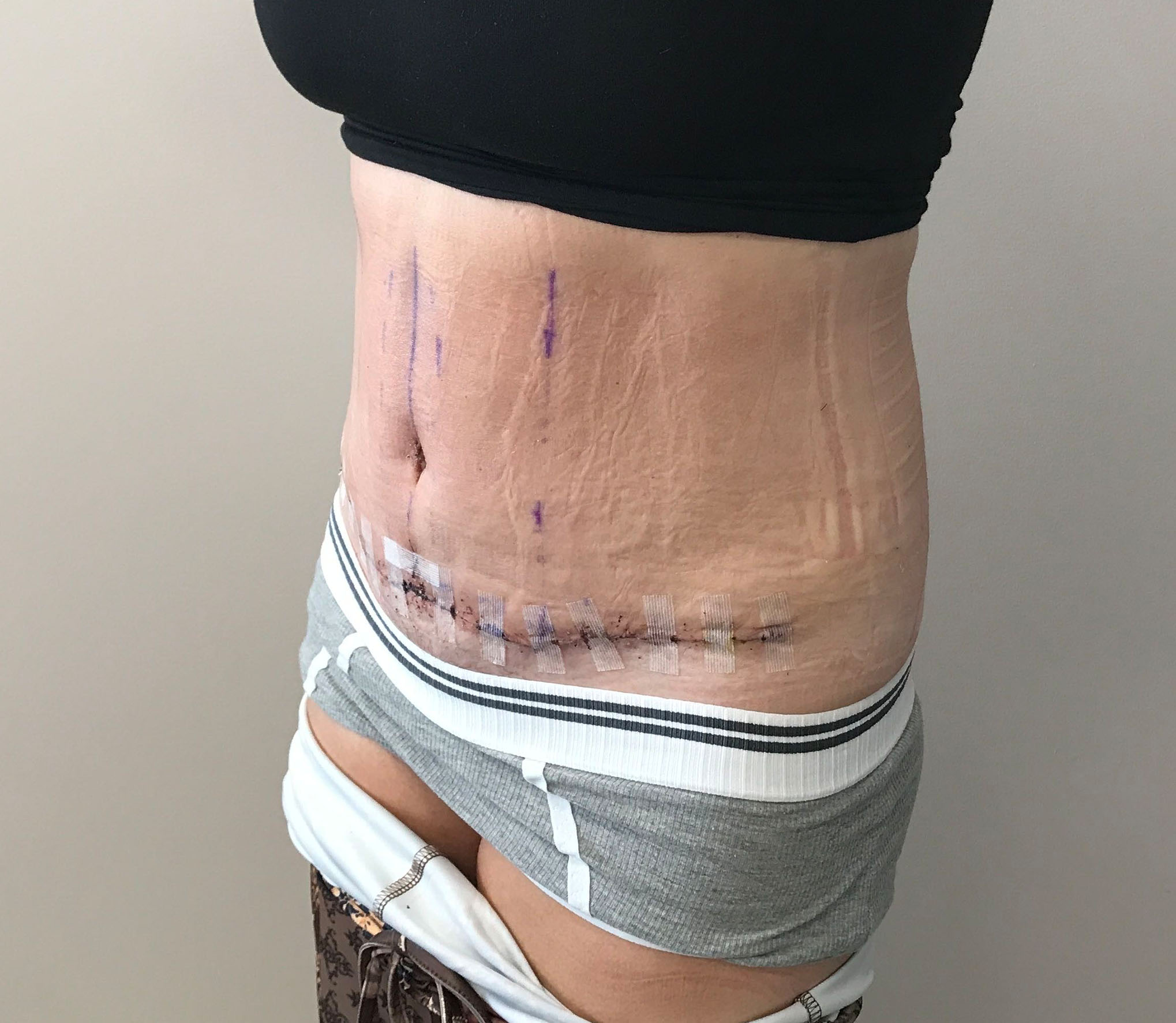 tummy tuck abdominoplasty before and after results cincinnati ohio