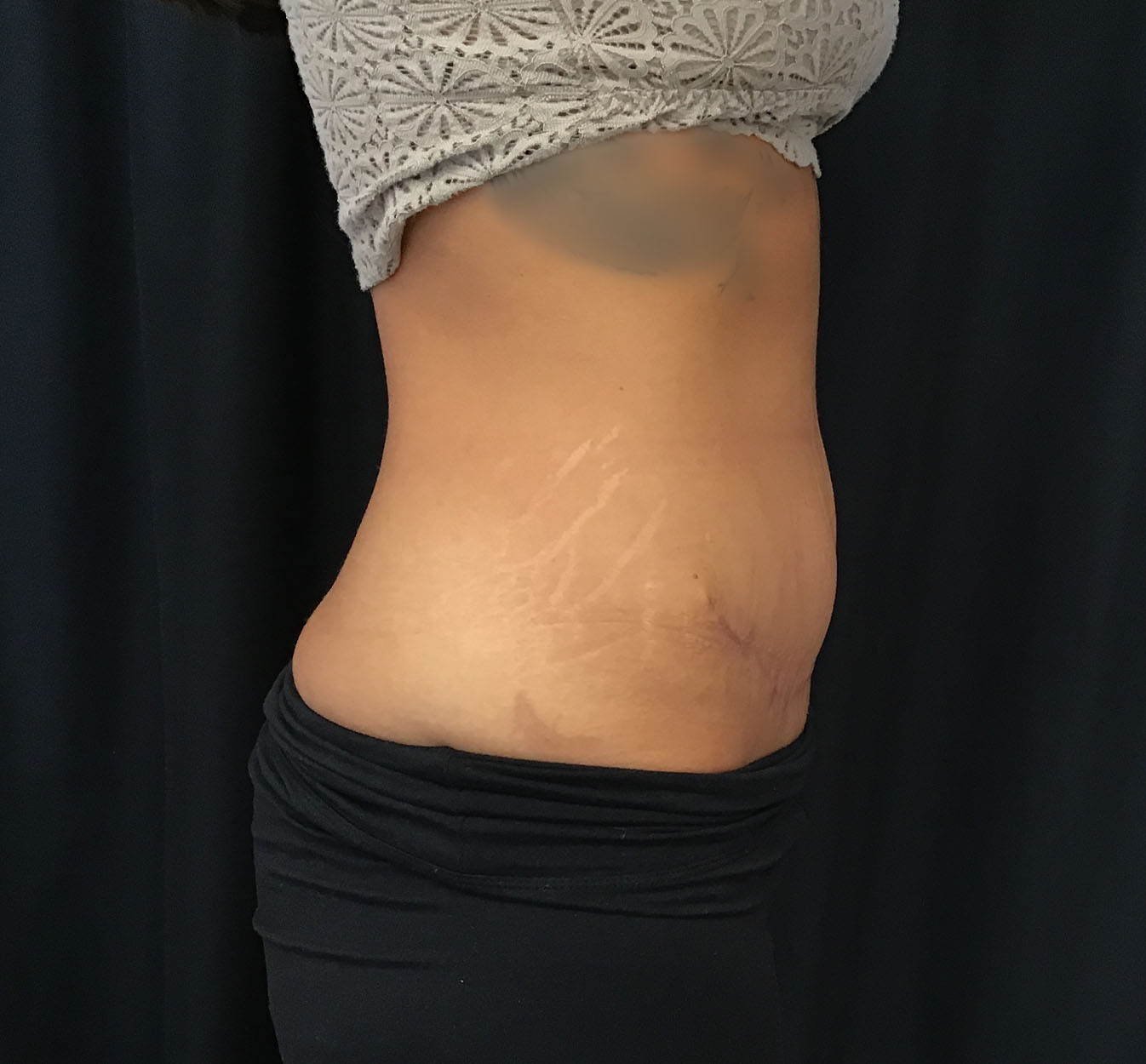 tummy tuck abdominoplasty before and after results cincinnati ohio