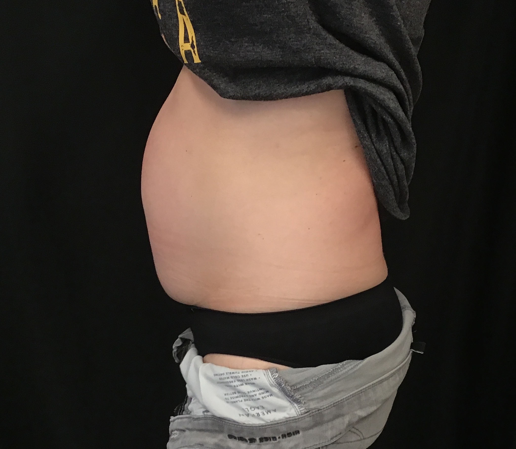 tummy tuck abdominoplasty before and after results cincinnati ohio