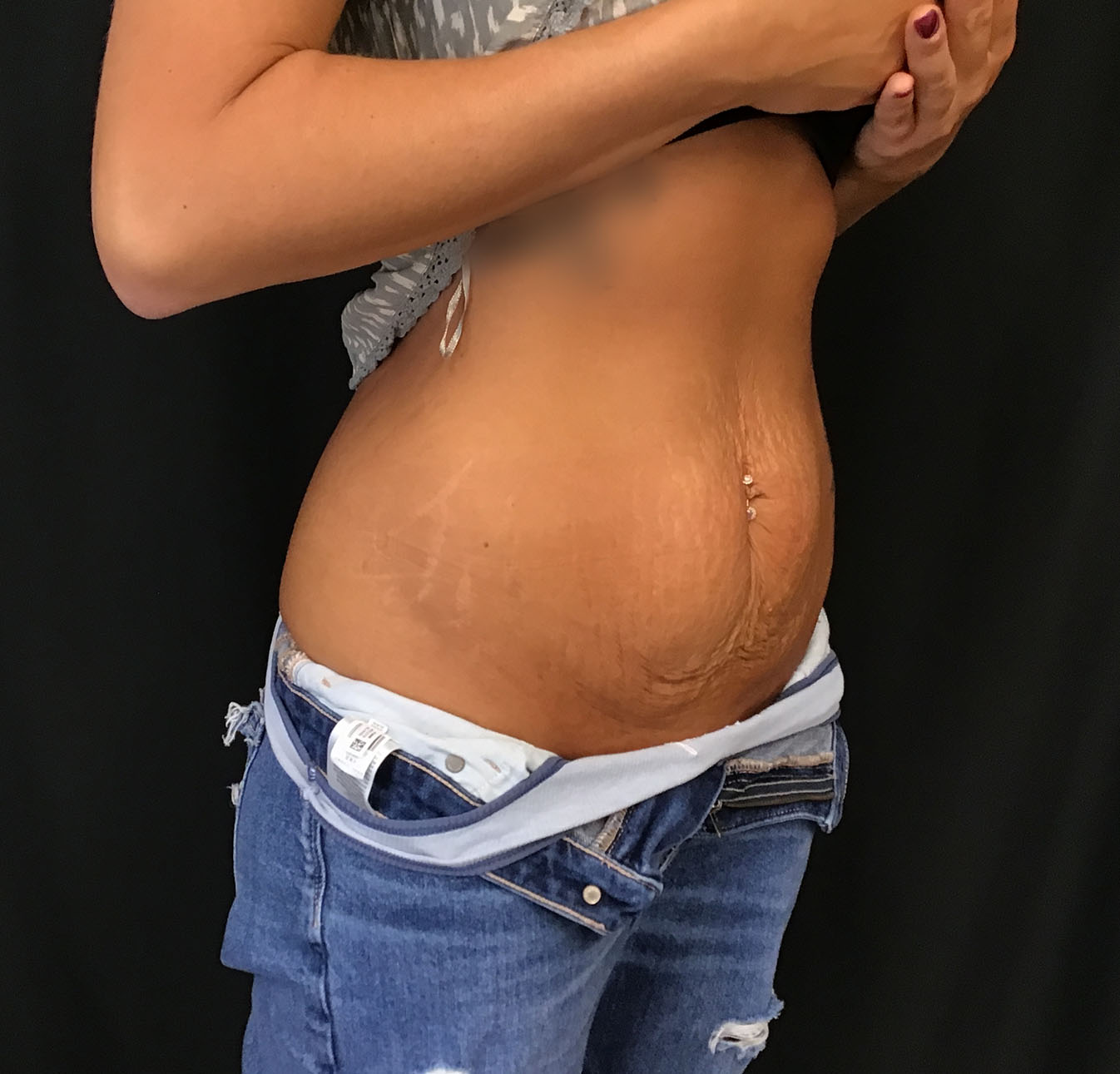 tummy tuck abdominoplasty before and after results cincinnati ohio