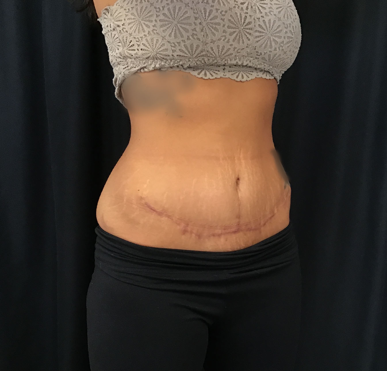 tummy tuck abdominoplasty before and after results cincinnati ohio