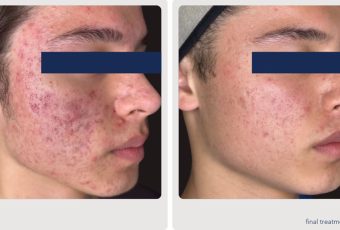 Acne Treatment That Works with AviClear