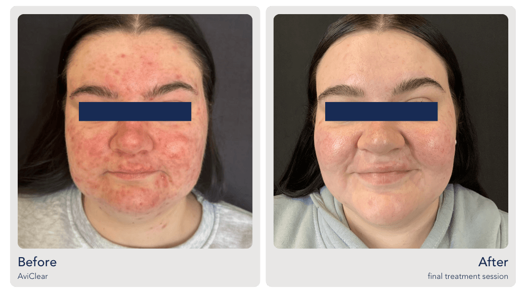 aviclear acne treatment for teens