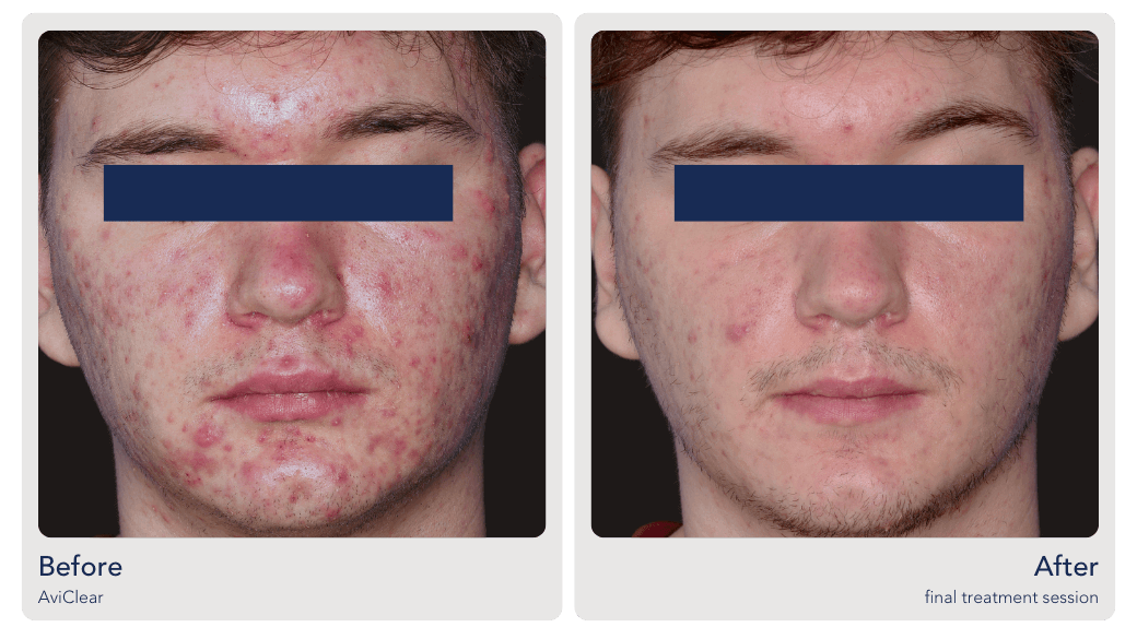 aviclear acne treatment for teens