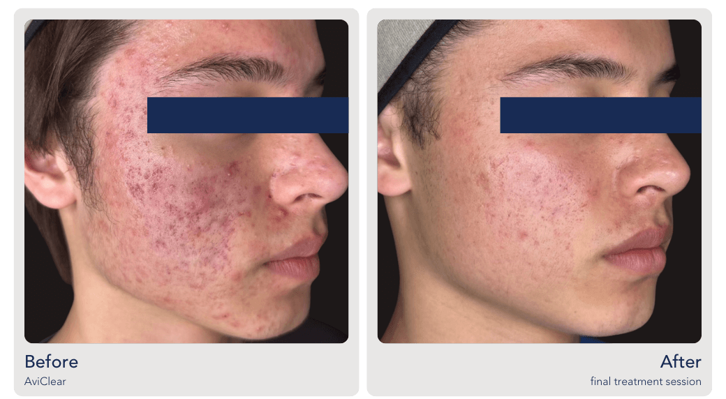 aviclear acne treatment for teens