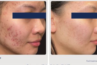 Best Acne Treatment for Teens: Why AviClear is Changing the Game