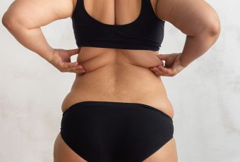 Best Bra Fat Reduction Treatment Without Surgery