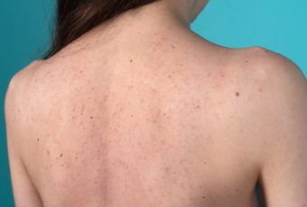 Best Treatment for Back Acne with AviClear Laser