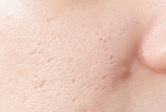 How to Get Rid of Large Pores: Best Treatments in Cincinnati, Ohio