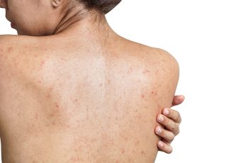 Say Goodbye to Bacne with AviClear