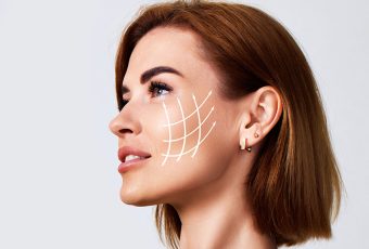 Instant Thread Facelift in Cincinnati, Ohio
