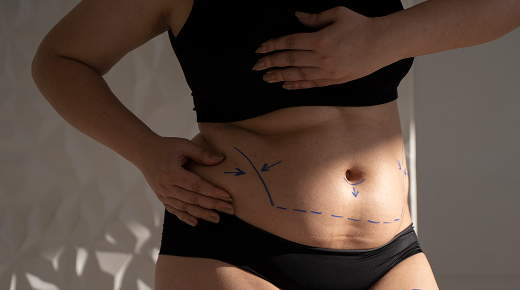 tummy tuck abdoinoplasty cincinnati ohio 