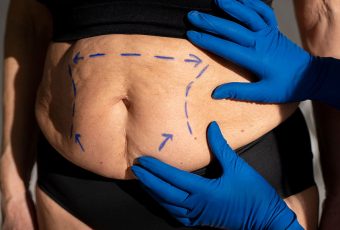 What Is the Recovery Time for a Tummy Tuck?
