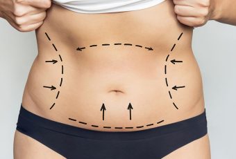 What Is the Weight Requirement for a Tummy Tuck?