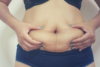 Will My Belly Be Flat After a Tummy Tuck?