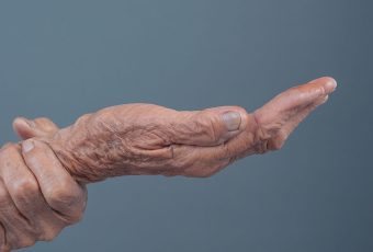 Are Hand and Arm Veins Treatable with Sclerotherapy?
