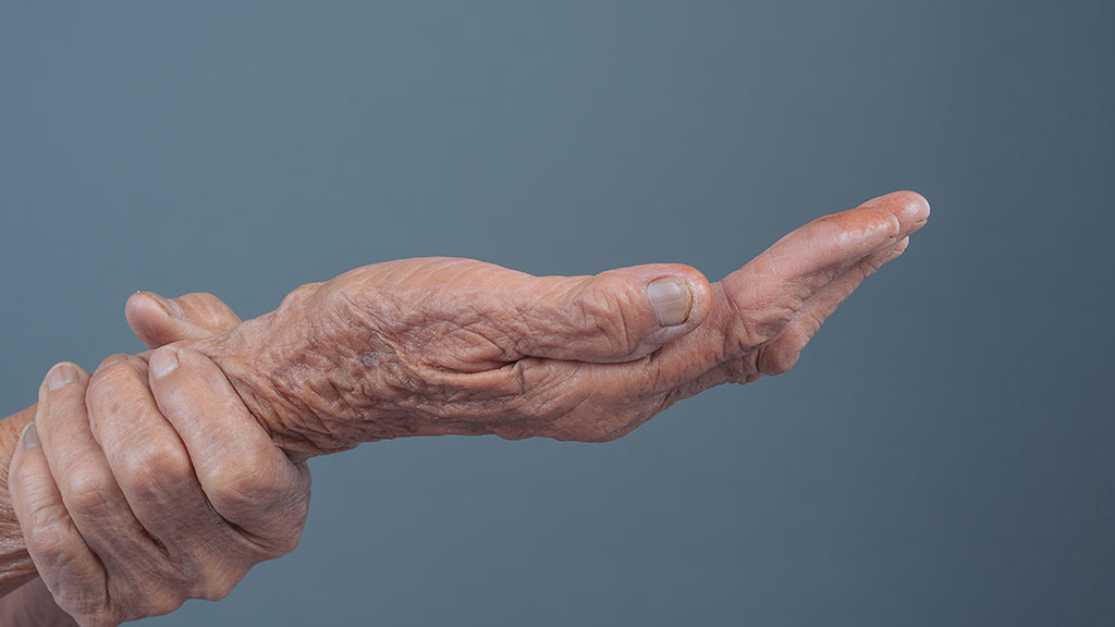 Are Hand and Arm Veins Treatable with Sclerotherapy cincinnati