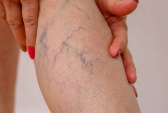 Can Sclerotherapy Treat Veins on the Thighs, Ankles, or Feet?
