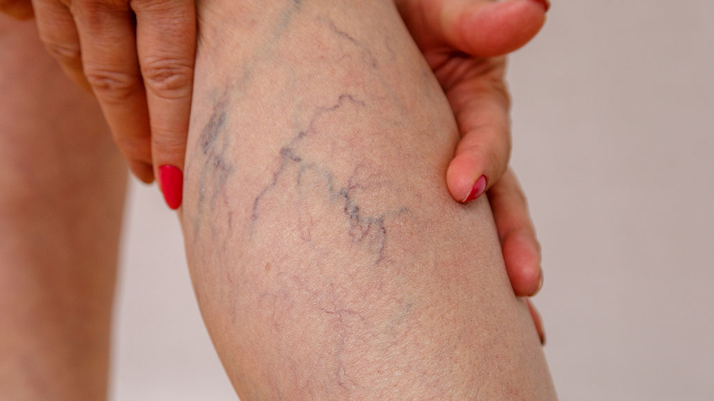 Can Sclerotherapy Treat Veins on the Thighs Ankles or Feet Cincinnati