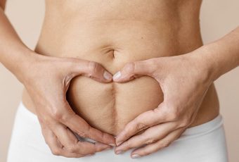 Can VelaShape Help Tighten Loose Skin on the Abdomen?