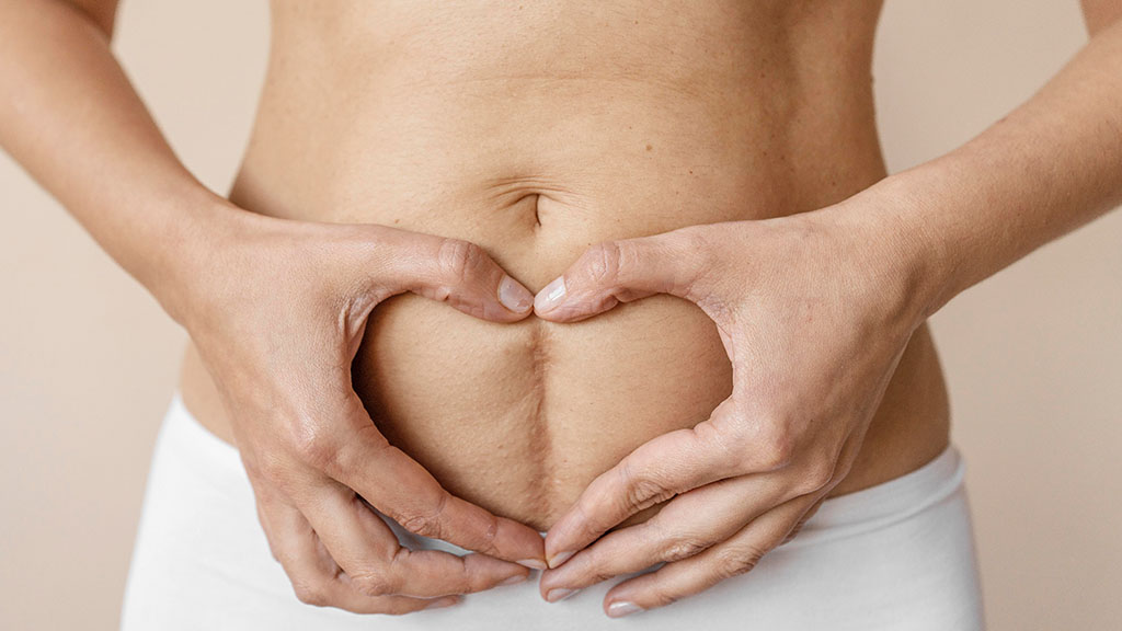 Can VelaShape Help Tighten Loose Skin on the Abdomen cincinnati