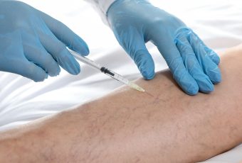 Does Sclerotherapy Hurt? What the Treatment Feels Like