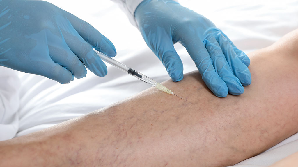 Does Sclerotherapy Hurt What the Treatment Feels Like cincinnati