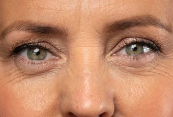 EMFACE Eyes for Hooded Eyelids: Can It Really Lift the Brow?