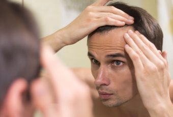 Hairline Lowering with SmartGraft: What to Expect from a Precision Hair Transplant