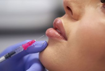 Marionette Line Fillers: Rejuvenate the Corners of Your Mouth