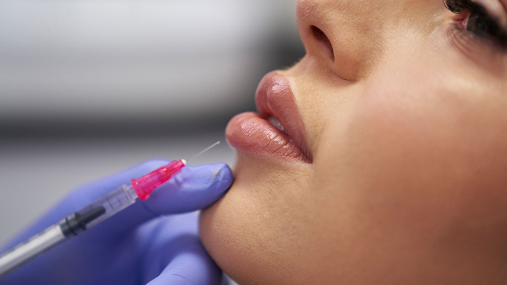 Marionette Line Fillers Rejuvenate the Corners of Your Mouth