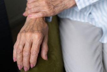 Sclerotherapy Treatment for Hand Veins: Safe, Proven, and Effective