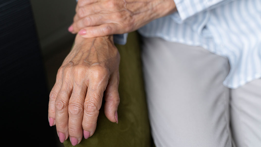 Sclerotherapy Treatment for Hand Veins Safe Proven and Effective cincinnati
