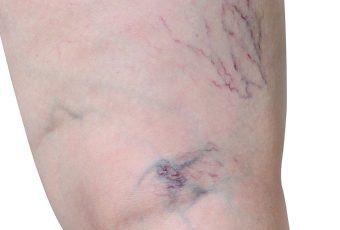 Sclerotherapy vs. Laser Vein Treatment: Which Is Better for Spider Veins?