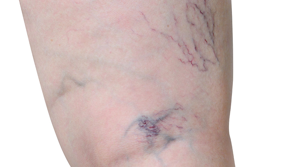 Sclerotherapy vs Laser Vein Treatment Which Is Better for Spider Veins cincinnati