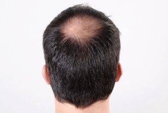 SmartGraft for Crown Thinning: Fill in Bald Spots Naturally