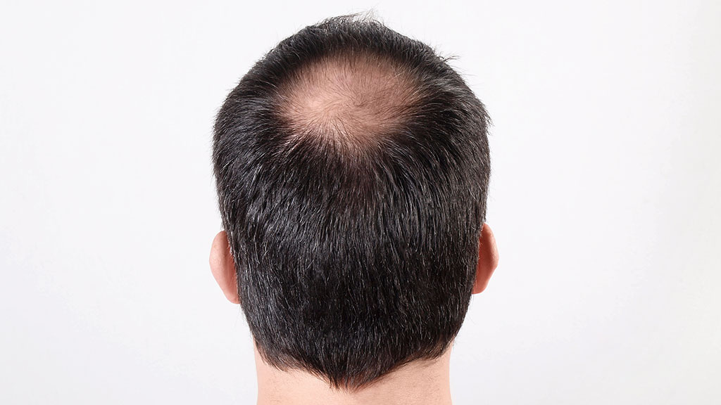 SmartGraft for Crown Thinning Fill in Bald Spots Naturally cincinnati