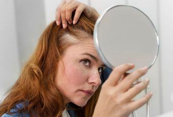 SmartGraft for Female Hair Loss: Safe, Effective, and Scar-Free