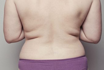 Vanquish for the Back: Eliminate Stubborn Bra Bulge Without Downtime