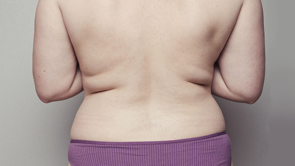 Vanquish for the Back Eliminate Stubborn Bra Bulge Without Downtime cincinnati